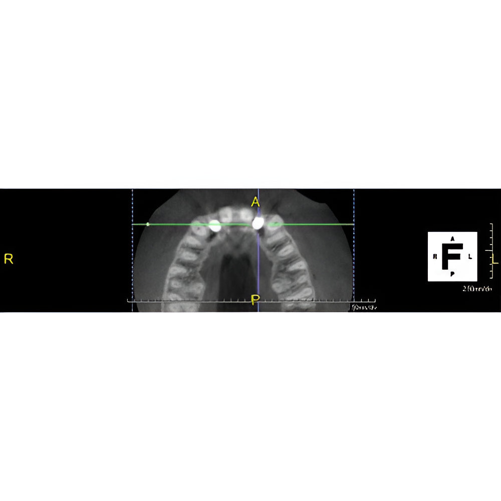 PreXion Excelsior Pan + CBCT (15x8 FOV) with PC, Software, Installation, Shipping and Warranty