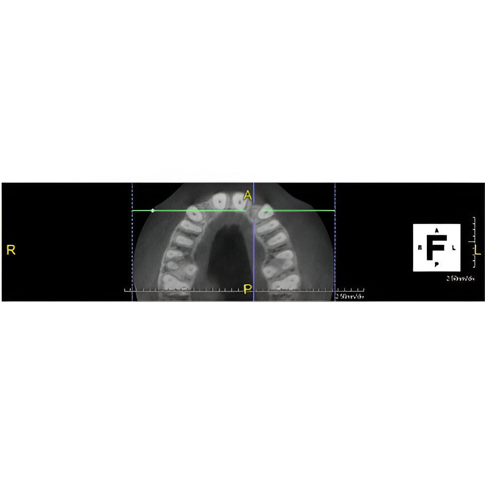 PreXion Excelsior Pan + CBCT (15x8 FOV) with PC, Software, Installation, Shipping and Warranty