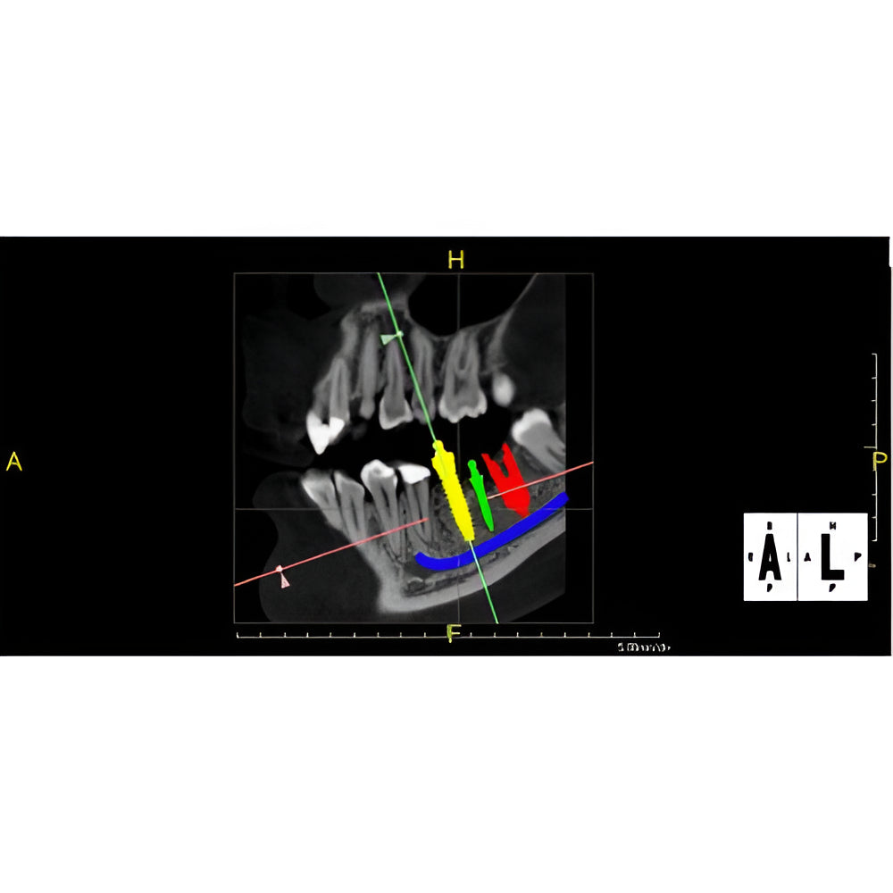 PreXion Excelsior Pan + CBCT (15x8 FOV) with PC, Software, Installation, Shipping and Warranty