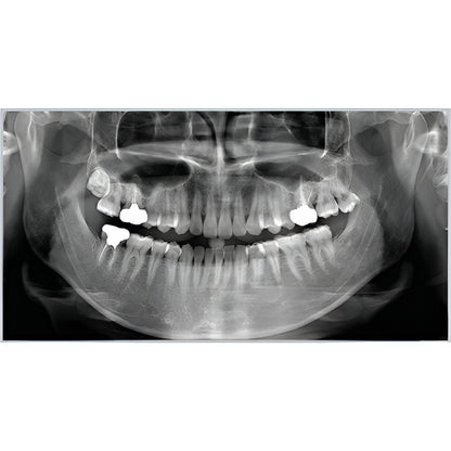 RayScan Alpha Pan + CBCT (10x10 FOV)
