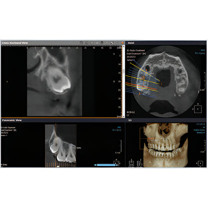 RayScan Alpha Expert Pan + CBCT (9x9 FOV) with PC, Software, Installation, Shipping and Warranty