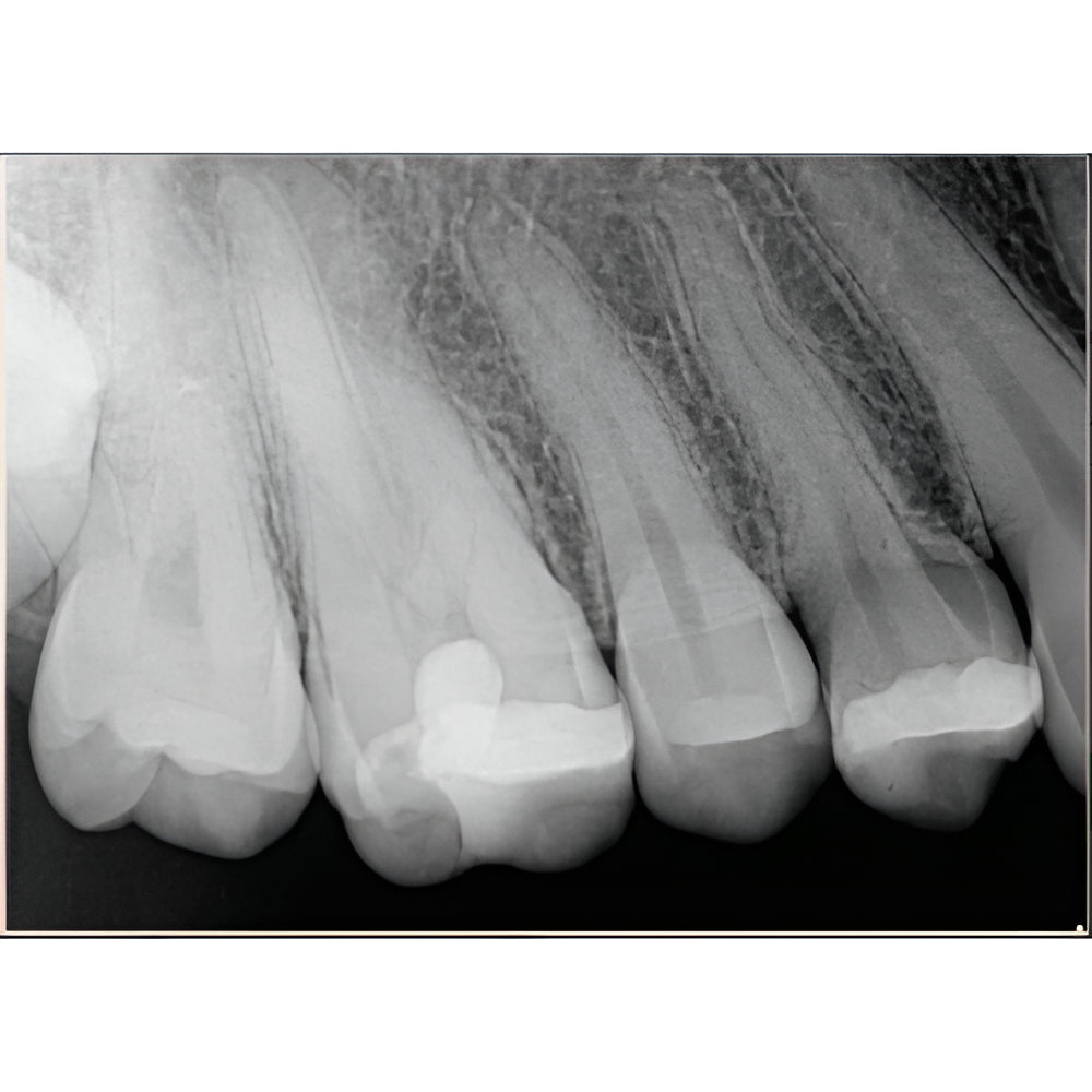 Chairside Imaging Bundle - MobileX Handheld Xray Generator and 2 x Schick CDR Elite Sensors