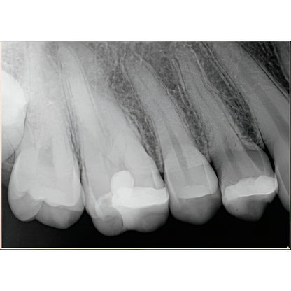 Chairside Imaging Bundle - MobileX Handheld Xray Generator and 2 x Schick CDR Elite Sensors